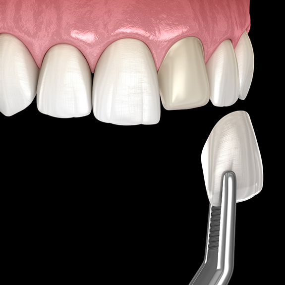 Illustration of veneer being placed on a tooth