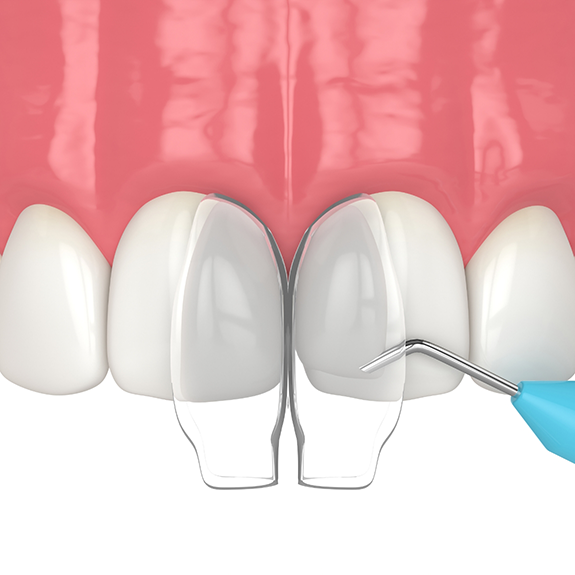 Cosmetic bonding being performed on upper teeth