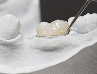 Dental crown attached to model of teeth