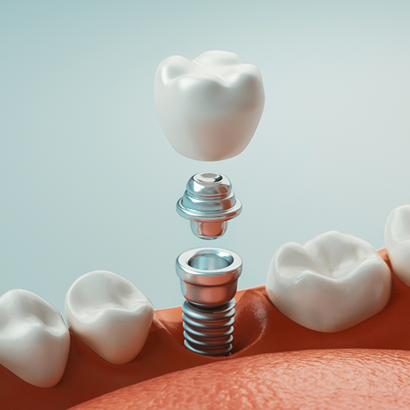 Illustration of dental implant in Flower Mound with dental crown and abutment being placed