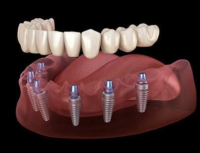 Illustrations of dentures being attached to dental implants