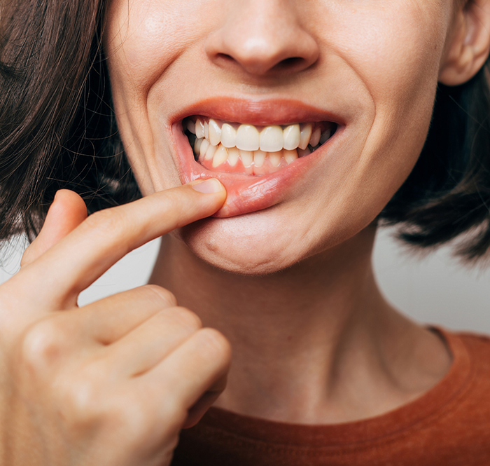 Woman pulling down lip to show her gums