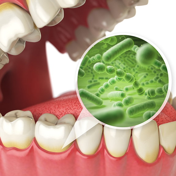 Illustration of bacteria living in gums