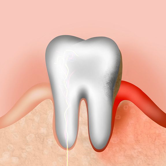 Illustration of tooth and inflamed gum tissue