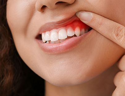 Woman lifting lip to show inflamed gums