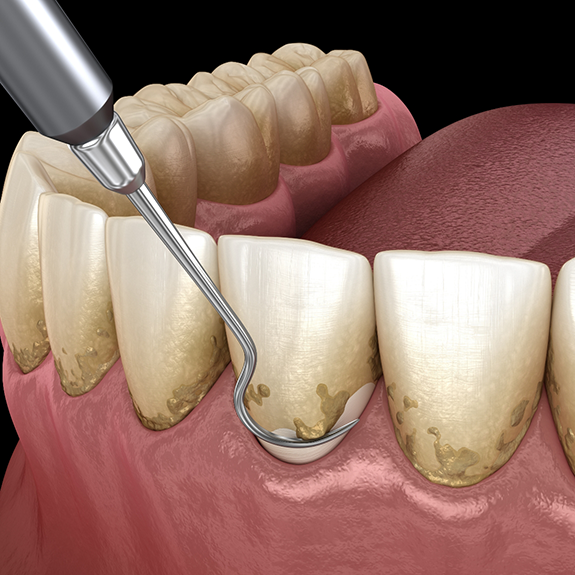 Illustration of scaling and root planing for lower teeth