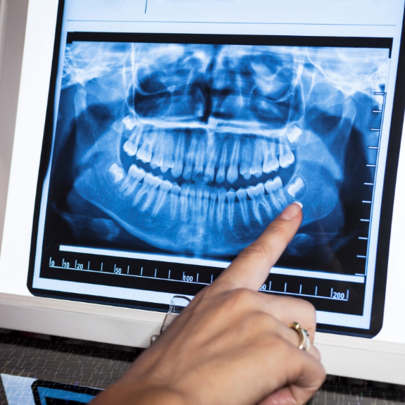 Pointing to an impacted wisdom tooth on a dental X-ray