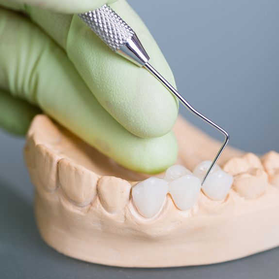 Working on dental bridge attached to model of teeth