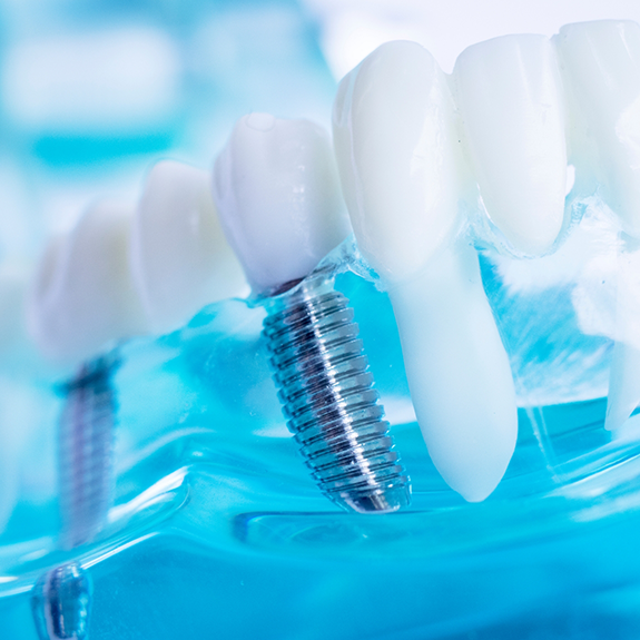 Pair of dental implants in plastic tray with model teeth