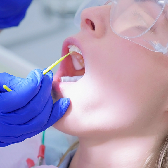 Applying fluoride to patient's upper teeth