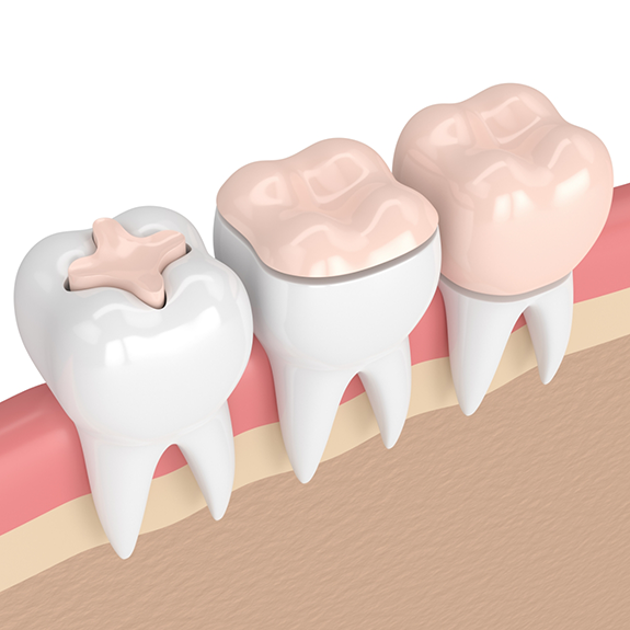 Illustration of teeth with different dental crowns