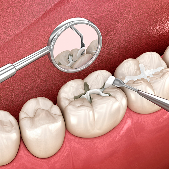 Illustration of a tooth-colored filling being placed