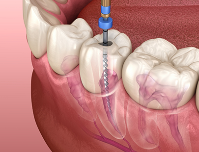 Illustration of root canal treatment in Flower Mound for lower tooth