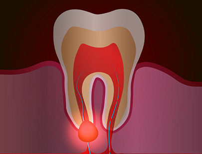 Illustration of tooth with an abscess