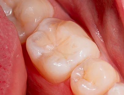 Close up of a tooth after a treatment