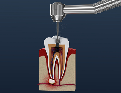 Illustration of tooth receiving root canal treatment