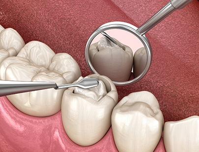 Illustration of filling being applied to tooth