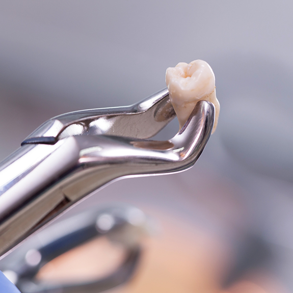 Close up of tooth held by forceps after tooth extraction in Flower Mound