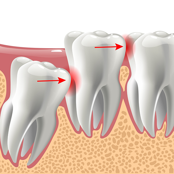 Illustration of wisdom teeth pressing on other teeth