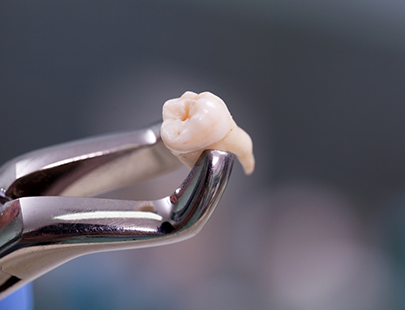 Extracted tooth held by metal forceps